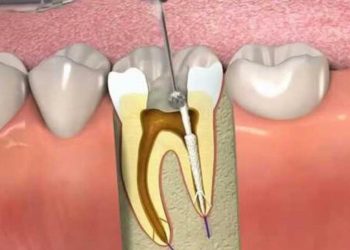 لە چ کاتێکدا ددانەکەت پێویستی بە دەمار بڕین هەیە ؟