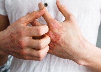 ئەگزیما نەخۆشیە درێژخایەنەکەی پێست