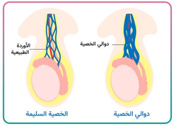 ئایا زالوی پزیشکی دەتوانێت جێگەی نەشتەرگەری دەوالی گون بگرێتەوە