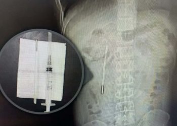 پیاوێک بۆماوەی بیست ساڵ گەرمی پێوی لەگەدەی مابووەوە