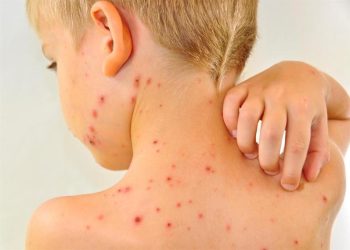 حەبێكی نوێ یارمەتیدەرە بۆ سنوورداركردنی بڵاوبوونەوەی سورێژە