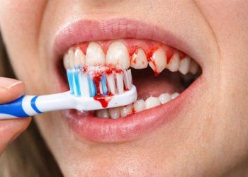 هۆکارەکانی خوێنبەربوونی پووک چیین ؟ 