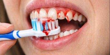 هۆکارەکانی خوێنبەربوونی پووک چیین ؟