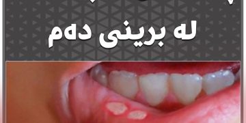 هۆكارە باوەكان و ڕێگاكانی خۆپاراستن لە برینی دەم